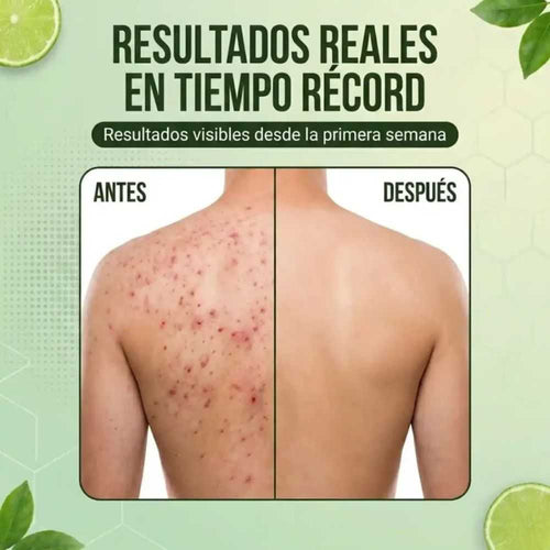BACK ACNE – Elimina granitos de la espalda y recupera una piel limpia